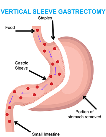 What to Expect After Gastric Sleeve Surgery - Recovery Guide